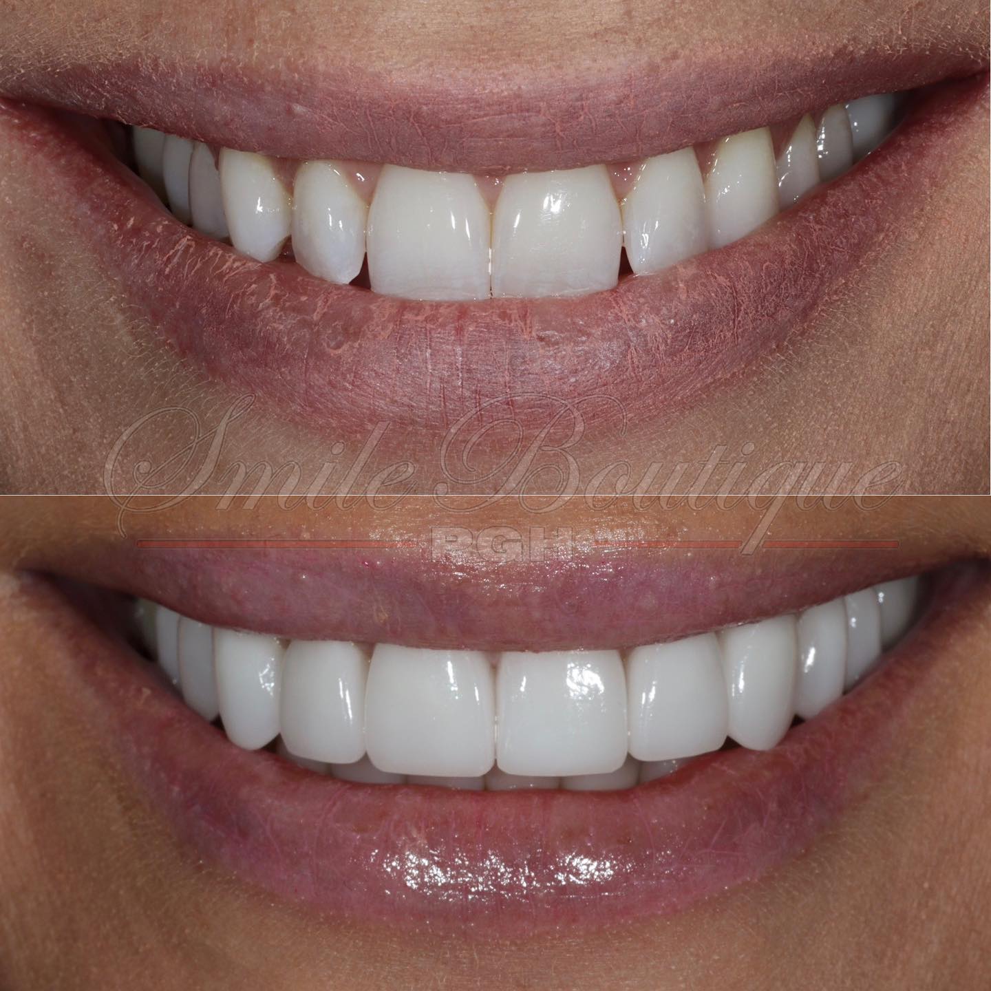 Monday Motivation 🤩
Featuring Miss @leamae825’s smile transformation 🙌
Her dislikes (✖️) & what we achieved (✔️):
✖️ Small teeth
✖️ Teeth sticking out
✖️ Uneven size teeth
✖️ Curved midline
✖️ Stained teeth
✔️ Balanced Smile
✔️ Brighter smile
✔️ Straighter teeth
✔️ Fuller smile
✔️ More teeth show
Procedure prescribed:
1️⃣ Invisalign
2️⃣ 10 LD ceramics by @jimmy_so_
Lea wanted her smile with specific shapes and certain look so we are thrilled that we’ve achieved a smile that she can now smile about 🤩 Another happy smiling patient 🙏
To learn more on how to get your winning smile, schedule your consult with link in bio.
#winning #winningsmile #mondayvibes #mondaymotivation #mondaymood #newsmile #sopretty #justwow #soamazing #smilemore #confidentwomen #confidence #confidentlybeautiful #confidentsmile #smiletransformation #smilemakeover #teethwhitening #pittsburghdentist #cosmeticdentistry #cosmeticdentist #topdentist #aacd #happypatient #anotherone #anotherhappycustomer #luxurylifestyle #treatyoself #lifechanger #changinglives