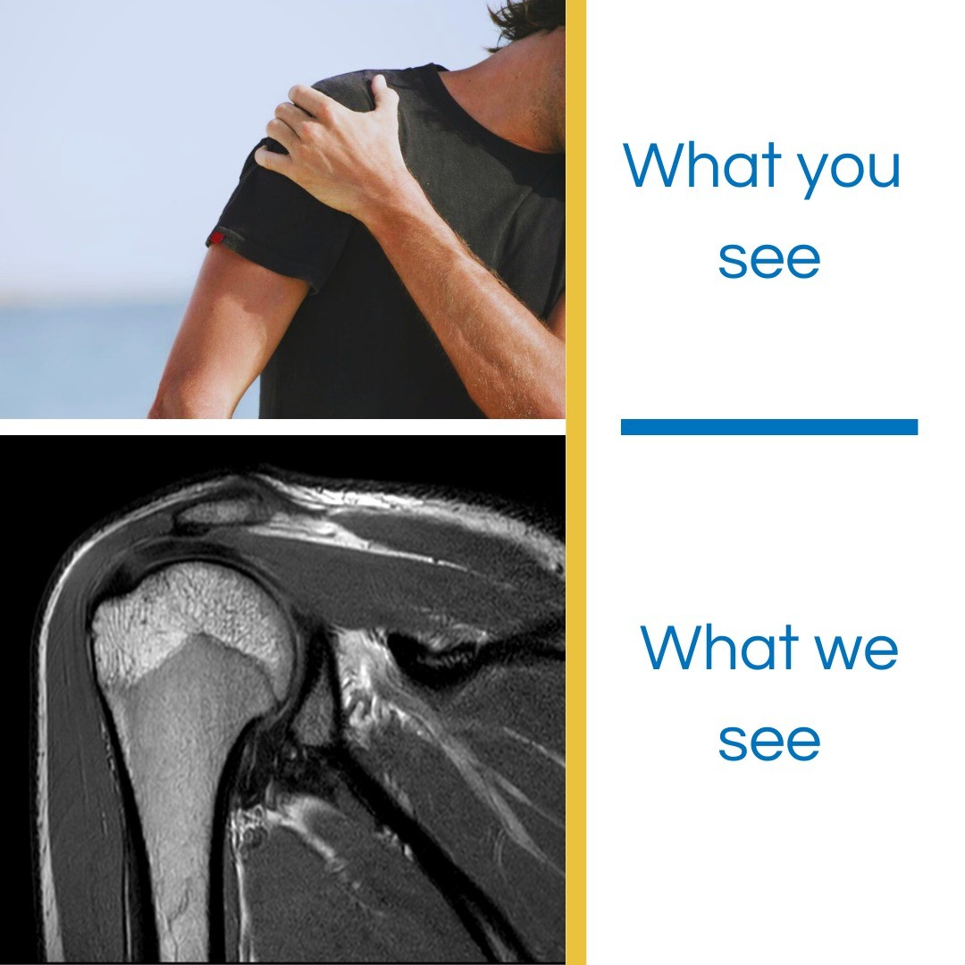 It's what on the inside that counts.
#weseerightthroughyou #MRI #shoulder #rotatorcuff #healthcare #kelowna #diagnosticimaging #whatsyourreason #shouldersofinstagram #notarealhashtag