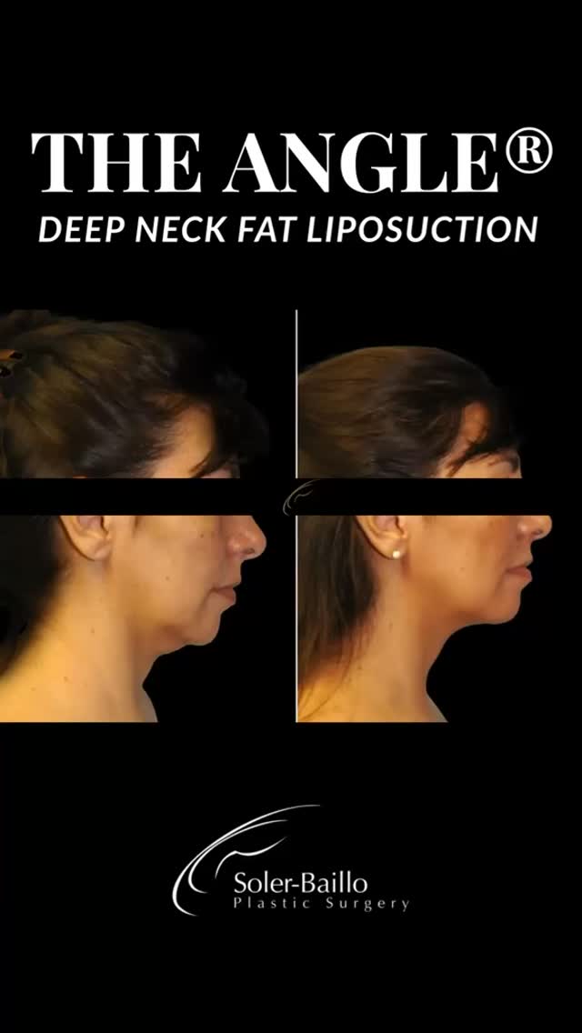 Reinvent yourself with ✨The Angle®✨.
A subtle, yet flawless transformation. Contact us to learn more today! 📞305-661-1996
#drsolerbaillo #whenresultsmatter #plasticsurgerymiami #chinliposuction #deepneck
