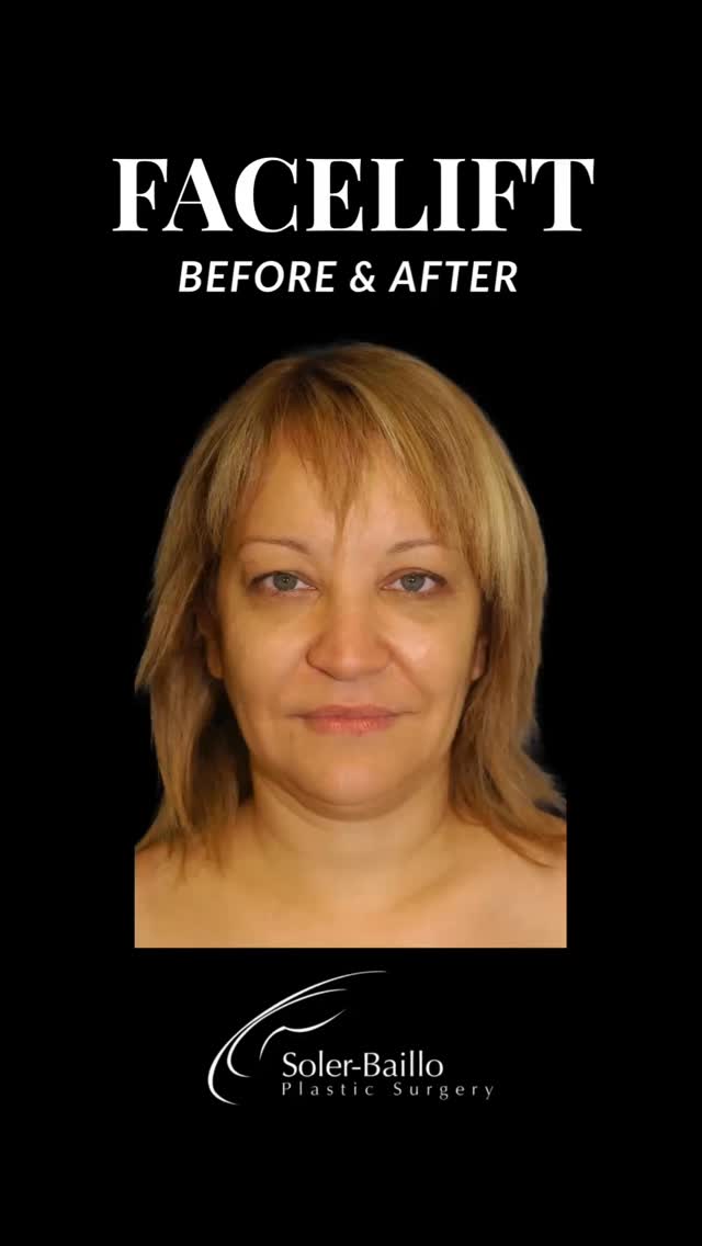 ✨ The power of transformation
Before and after facelift using our signature UpLyft™️ technique 💫 Notice the refreshed, lifted and natural results that bring out her true beauty without looking surgical.
The UpLyft™️ is designed for natural-looking rejuvenation with less downtime, minimally invasive deep plane facelift that combines the deep plane and SMAS technique giving you a more youthful, confident look.
📍Performed in Coral Gables, Fl by Board Certified Plastic Surgeon @drsolerbaillo
💭 Have questions? Contact us today!
(305) 661-1996
#facelift #beforeandafter #plasticsurgery #boardcertifiedplasticsurgeon #southflorida #miami