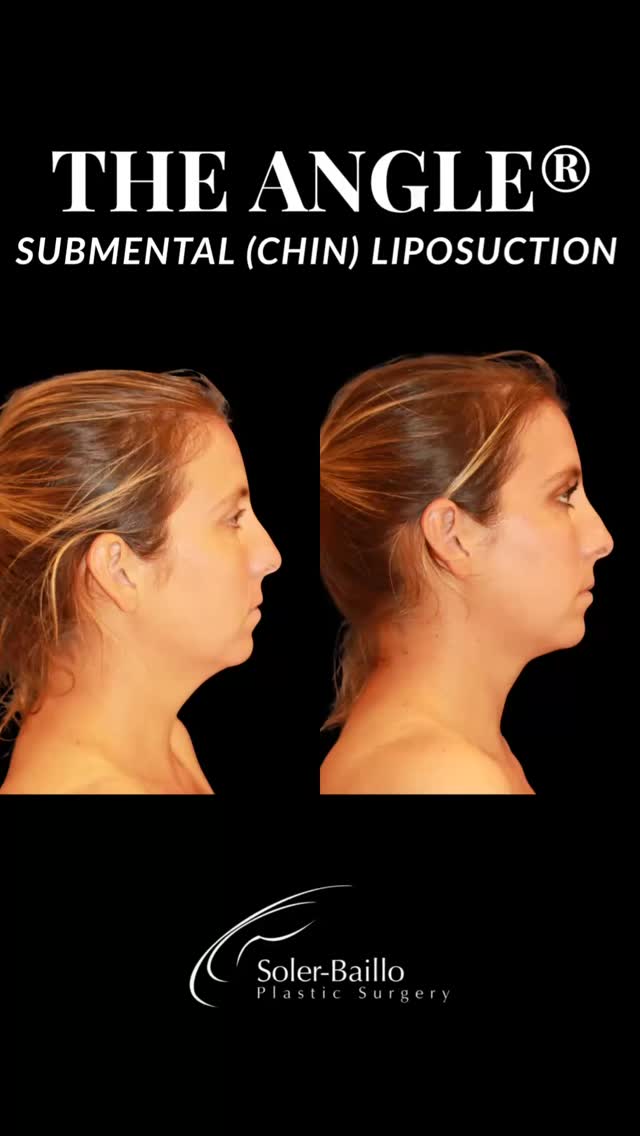 💖The Angle® by Dr. Soler-Baillo.
Say goodbye to a double chin and hello to a beautifully sculpted neck and jawline! The Angle® combines submental/chin/neck liposuction with subcutaneous micro dermal sculpting, a technique perfected by Dr. Soler-Baillo to:
✅Sculpt the neck and jawline
✅Tighten skin for a smoother, firmer appearance
✅Make patients look younger, thinner, and more confident
All in under 30 minutes - minimal downtime, maximum results. 💎
Ready to redefine your profile? Book your consultation today.
📱305-661-1996
💌 info@resultsmd.com
#theangle #chinliposuction #neckliposuction #submentalliposuction
