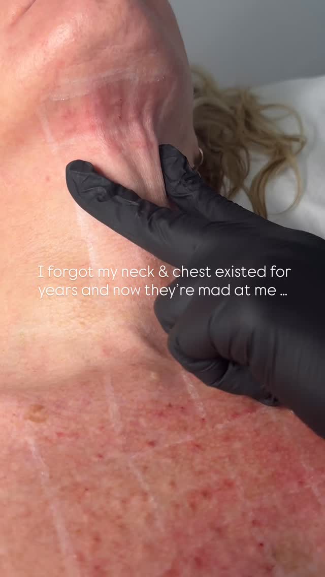 Polynucleotides and all is forgiven 🧬
Because they don’t just hydrate the skin! They repair it.
As in: rebuild collagen, restore elasticity, improve thickness and smoothness.
This treatment is for you if you’re noticing:
• Crepey, thin neck skin
• Chest lines from side sleeping
• Sun damage
The results -
• Softer, smoother texture
• Firmer, tighter skin
• Improved elasticity + bounce
• That “expensive skin up close” look
No filler.
No fake volume.
Just your skin reverse aging.
📍 Ultra Aesthetics
#UltraAesthetics #Polynucleotides #NeckRejuvenation #ChestRejuvenation #SkinRepairNotFiller #LiverpoolAesthetics #ScouseGlow #FreshNotFrozen #ExpensiveSkin #NaturalResultsOnly