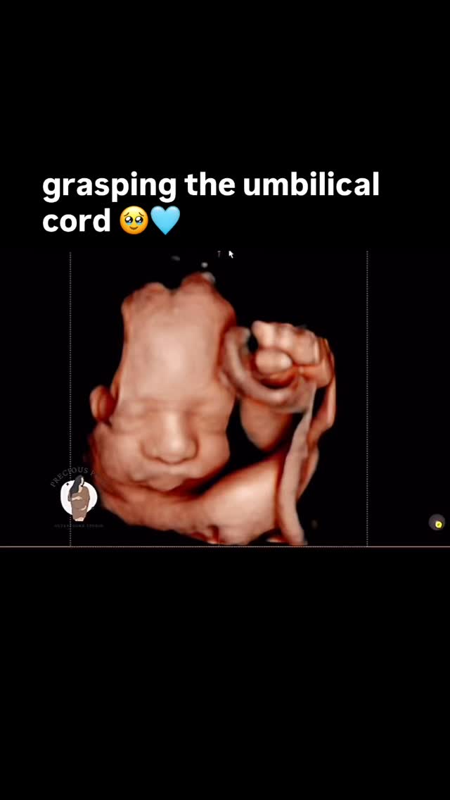 Babies like to play and nom on the umbilical cord in the womb 🤭🥰
#pregnant #pregnancy #ultrasound #genderreveal #explorepage