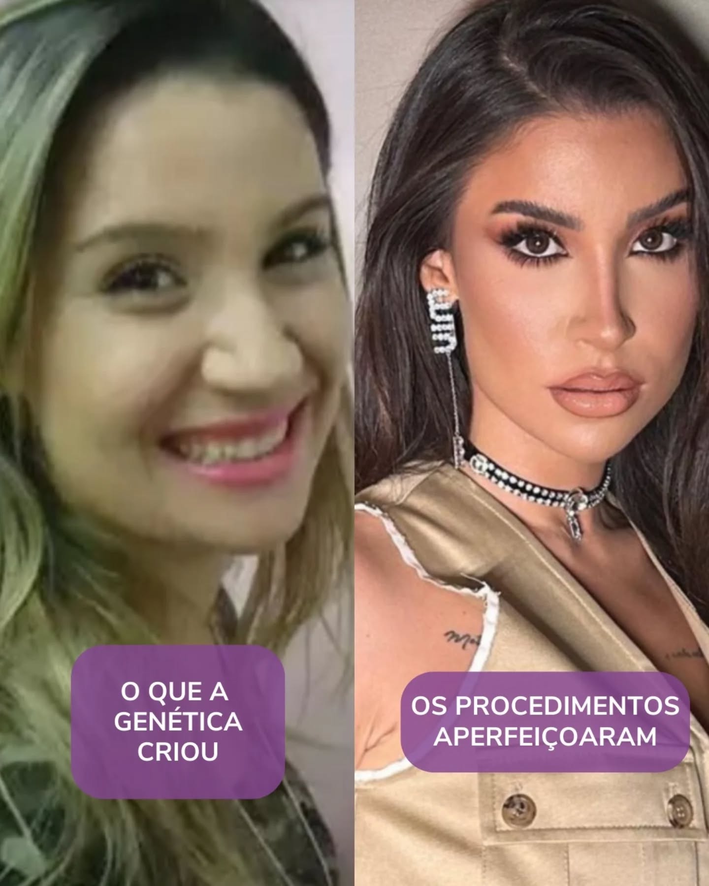 Essas artistas são a prova de que a genética faz um lindo trabalho, mas que procedimentos estéticos, quando bem feitos, planejados e bem indicados podem levar a sua beleza a um outro nível ✨️😉
Entre em contato e saiba mais!
#plasticasegura #cicurgiaplastica #cirurgiaoplastico #rejuvenescimentofacial