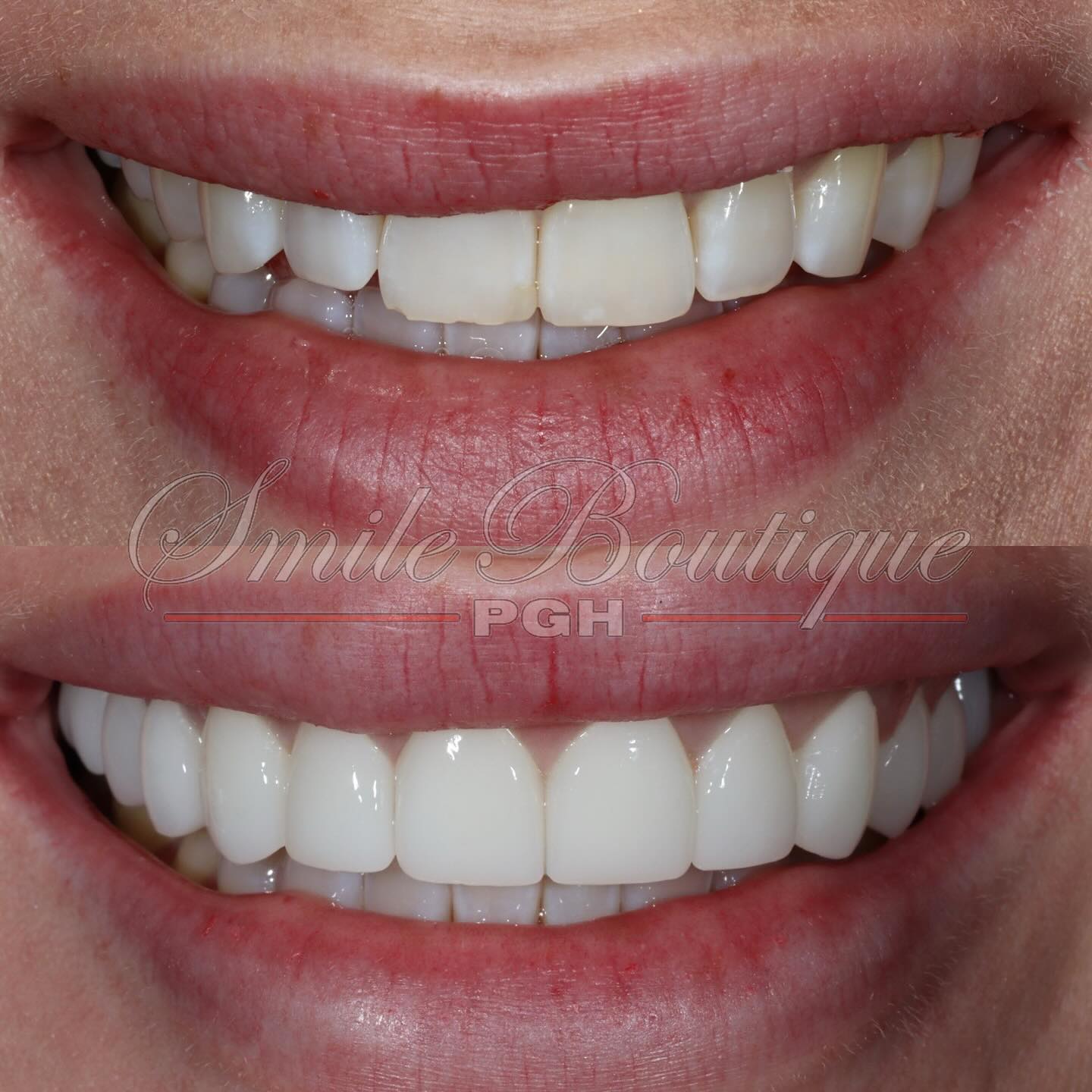 Friday Smile Feature 💫
Had the wonderful privilege to meet & work with @seriouslybritt on her smile who came to me complaining about how she dislike her smile. Her smile concerns were:
1️⃣ teeth not showing enough when she smiles
2️⃣ smile is bright enough
3️⃣ teeth are chilling and wearing thin
Transformation with 12 units achieved the following:
Crooked smile ➡️ Balanced Smile
Missing Tooth ➡️ Tooth is back!
Asymmetry ➡️ Symmetry
Narrow Smile ➡️ Wider / fuller Smile
Not so Bright Smile ➡️ Bright Smile
Small Teeth ➡️ More Teeth Show
End Result = A happier and more confident patient who now smiles more 🤩
Are you seeing similar issues with your smile? Book a consult meeting to learn more and start your personalized smile transformation journey (link in bio).
#friyay #flashbackfridays #tgif #fridayvibes #fridaymood #fridayfeature #endofyear #smilemore #smiletransformation #smilemakeover #smiles #smiledesign #cosmetic #cosmeticdentistry #cosmeticdentist #pittsburgh #pittsburghdentist #topdentist #wowsmile #happypatients #newyearnewme #newyearnewyou #treatyourself #luxurylifestyle #sexysmile #beyou #beconfident #whosnext #alwayssmile #loveit