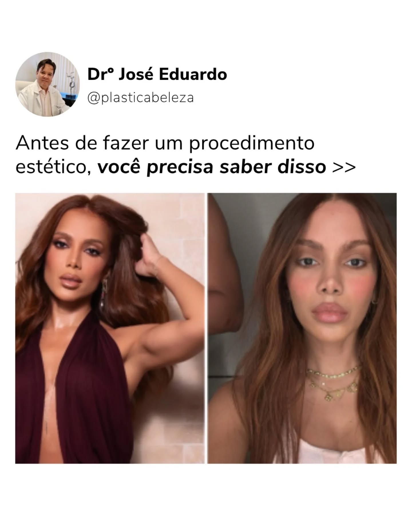 Você já pensou sobre o real motivo por trás de um procedimento estético?
A Anitta voltou às redes após mais uma intervenção e reacendeu um debate importante: a diferença entre se transformar por si mesma ou pela pressão externa.
Neste carrossel, trouxe reflexões que vão além da estética: sobre autoestima, responsabilidade e liberdade de escolha.
Compartilha com alguém que precisa ler isso hoje!
#plasticaemsantos #cirurgiaoplastico #cirurgiaplasticaemsantos #Santos #baixadasantista #anitta