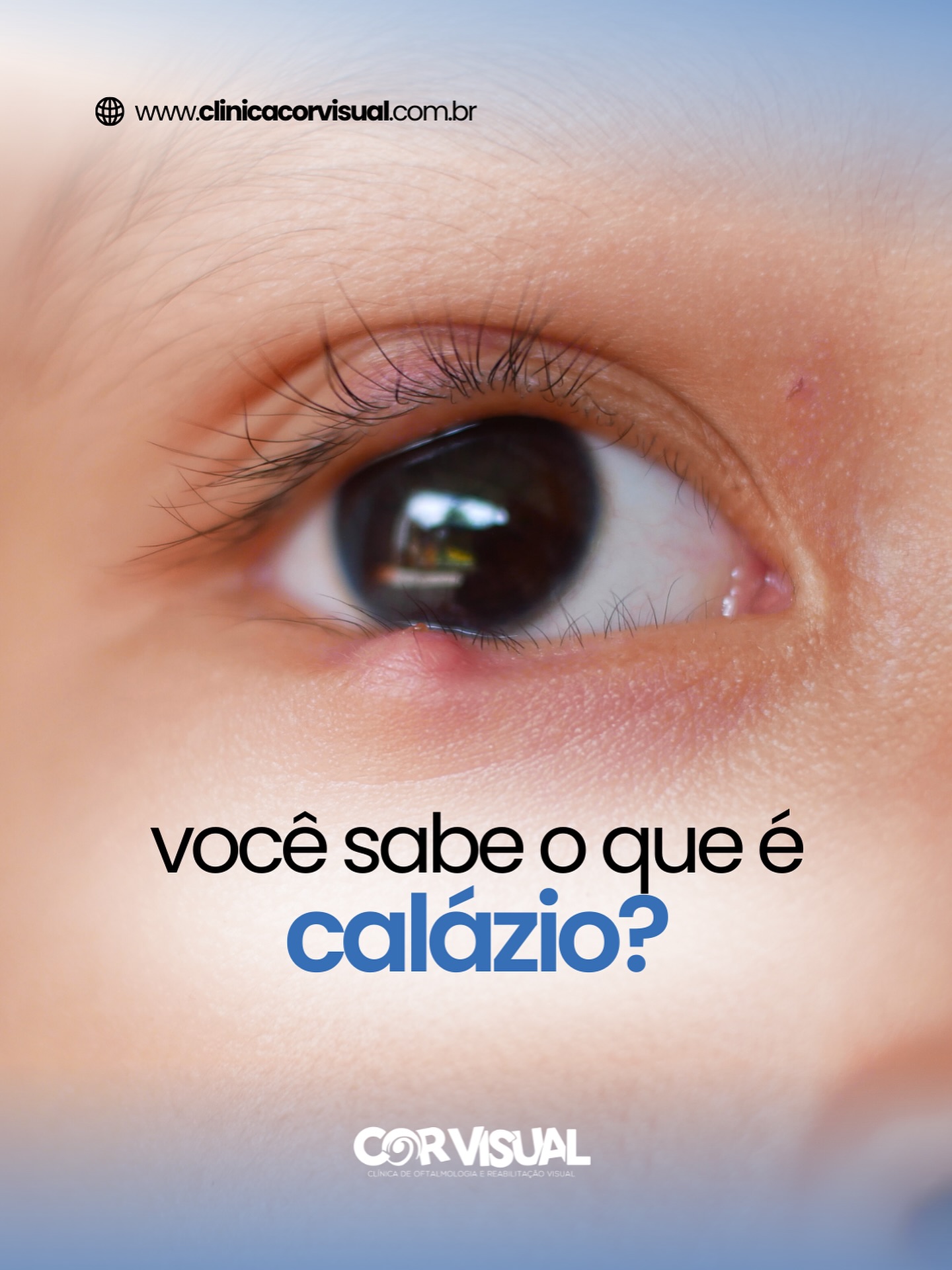 Um carocinho apareceu na sua pálpebra e você não sabe o que é? Pode ser um #calázio, uma condição comum, mas que muitas vezes gera dúvidas! 👁️
Entender o que é e como cuidar faz toda a diferença para evitar complicações! ⚠️
🔹 O que é: o calázio é uma inflamação causada pelo entupimento das glândulas sebáceas das pálpebras.
🔸 Como surge: geralmente aparece como um caroço indolor, que pode aumentar com o tempo e causar incômodo estético ou até atrapalhar a visão.
🔹 O que fazer: compressas mornas ajudam no alívio, mas o acompanhamento oftalmológico é fundamental.
🔸 O que não fazer: não tente espremer ou furar o calázio, isso pode agravar a inflamação e causar complicações.
Aqui na Clínica Cor Visual, nossa equipe está pronta para cuidar da sua saúde ocular com atenção e tecnologia.
Agende já sua consulta e garanta uma visão protegida e saudável!
📍 Clínica Cor Visual
📞 (83) 3322.3590 / (83) 3063.3590
📲 WhatsApp (83) 99612.0813
-
Marketing e Produção Audiovisual: @Kactus.Agencia 🌵
#campinagrande #joaopessoa #paraiba #oftalmologista #oftalmologiapediatrica #oftalmologia #oftalmologistainfantil #clinicaoftalmologica #oftalmologistacampinagrande #oftalmologistacg #oftalmologistaparaiba #clinicadeoftalmologia #saudedosolhos #saudeinfantil #clinicacorvisual #corvisual #catarata #cirurigiadecatarata #lentesdecontato #lentedecontato #lentedecontatocampinagrande #RetinografiaOcular #Retinografia