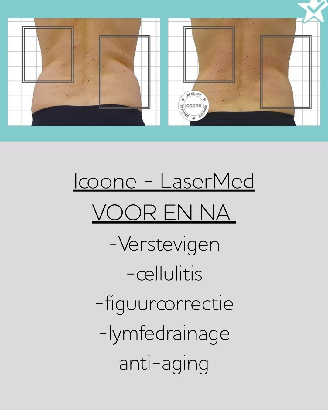 Last van vervelende huidplooien op je rug?
Last van vetophoping aan je BH-lintjes?
VOOR EN NA
Resultaat na 8 behandelingen
Meer info? Check onze website : www.switchlife.be
#huidversteviging #figuurcorrectie #vetverminderen #icoone