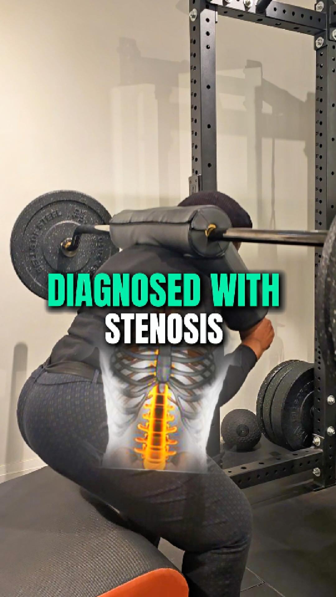Diagnosed with stenosis and told “never bend” or “never lift?
Here’s what you need to know.
Being told to avoid bending or lifting forever is not only unrealistic—it’s often harmful.
Bending down, picking things up, carrying groceries, tying your shoes, getting in and out of a car—these are essential human movements.
Avoiding them long-term leads to weakness, stiffness, fear of movement, and loss of independence.
A stenosis diagnosis is not a life sentence.
It’s a starting point, not a stop sign.
The goal isn’t to eliminate movement—it’s to rebuild capacity.
With the right progression, loading strategy, and coaching, you can safely bend, hinge, and lift again in ways that support your spine and your life.
Strength is what protects you. Confidence in movement is what restores freedom.
Our job is to help you navigate these scary diagnoses, cut through the fear-based advice, and get you back to functional levels you didn’t think were possible—so you can live fully, not cautiously.
If you’ve been told to “never do that again,” it’s time for a better plan.