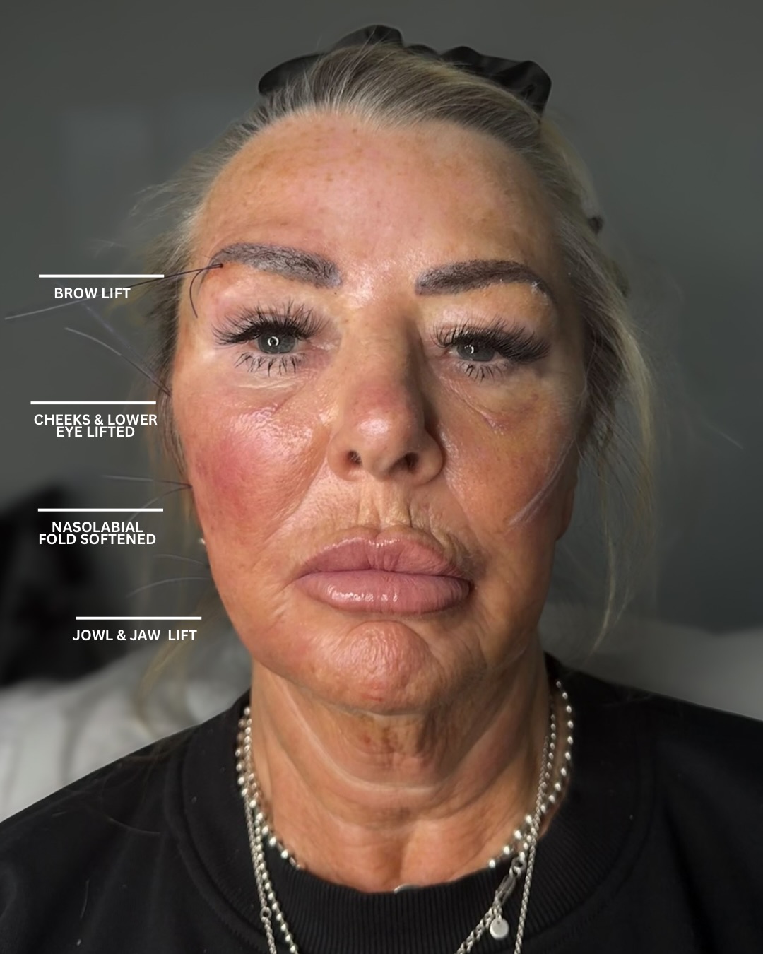 MODEL CALL — THIS FRIDAY
We’re looking for 5 women ready for a serious glow-up.
Advanced treatments to significantly lift the face and neck.
Heavily discounted, performed in-clinic by experienced practitioners.
✔️ PDO threads
✔️ Tox face & neck lift
✔️ Non-surgical facelift with filler
(cheeks, chin, jaw & lips)
This is for those who want real results, not fake - or unnatural !
📩 DM MODEL CALL to apply
📍 Ultra Aesthetics
⏰ This Friday only