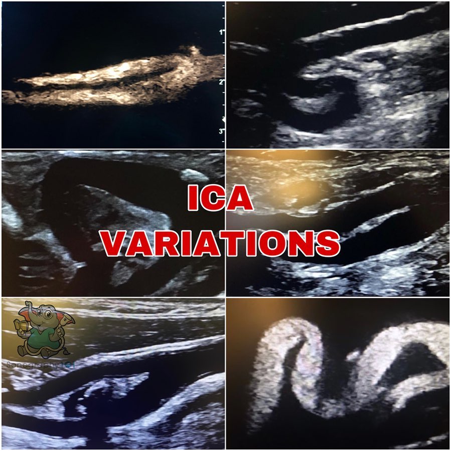 Which one do you enjoy scanning the most? Straight? C-Shaped? S-Shaped? When there’s some coiling or kinking? 😁
I honestly love them all 😍
.
.
.
.
#ultrasound #sonography #medicalsonography #RDMS #RVT #RegisteredDiagnosticMedicalSonographer #RegisteredVascularTechnologist #UltrasoundTechnologist #Sonographer #UltrasoundTech #Sonography101 #ultrasoundED #ultrasononography #ultrasonographer #Medicine #Medical #Radiology #Radiologia #Ultrasonido #DiagnosticImaging #Medicina #Sonograma
#sonographystudent #sonographyschool