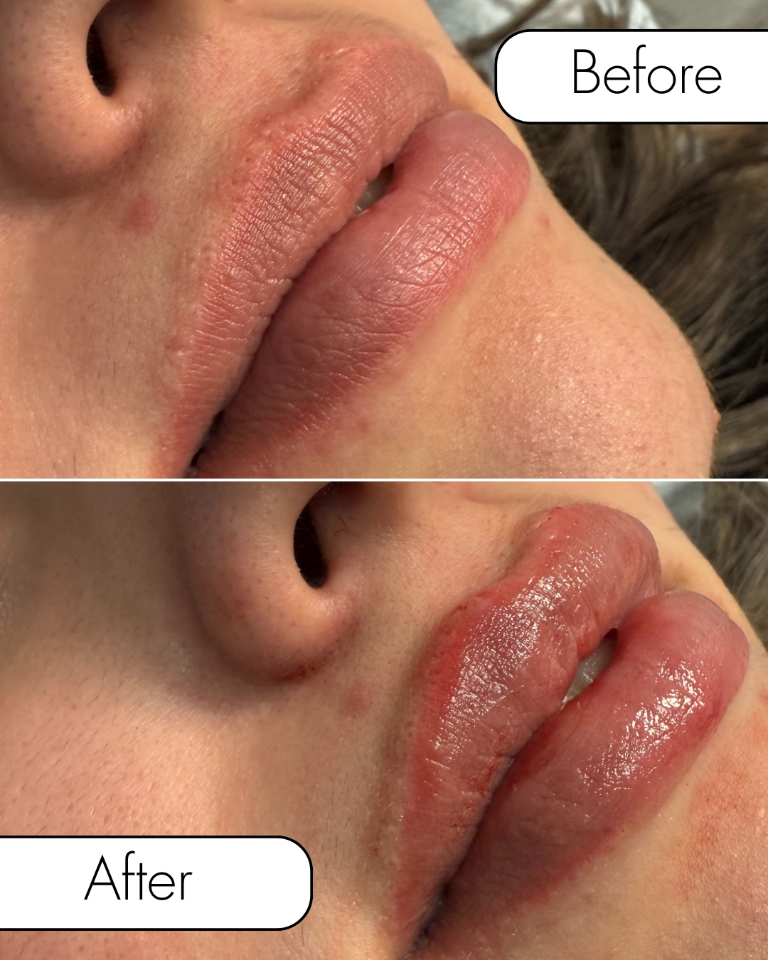 Pout goals 💋
💉 Subtle, natural lip enhancement
$349 per person when you bring a friend & split a syringe
Now through February 28th
👯♀️ Perfect excuse for a glow-up date
Book now!
📞 520-618-0232
➤ 2732 N. Alvernon Way, Tucson, AZ
➤ www.renew360az.com
#ReNew360 #TucsonArizona #LipFiller