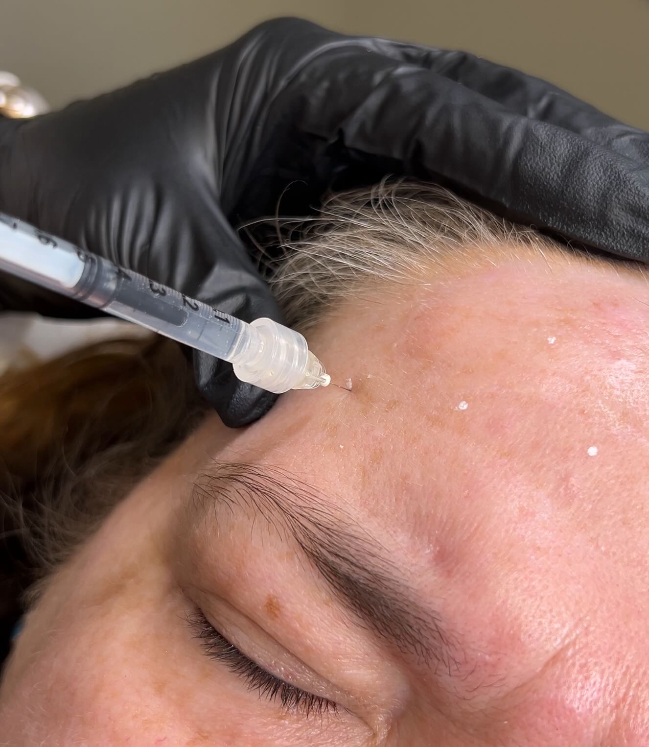 Smooth, natural results > frozen faces.
At Elevate, softening lines with Xeomin is all about precision and intention. We assess your muscle movement, map strategically, and dose conservatively so you still look like you—just more refreshed.
Xeomin is a “naked” neurotoxin (no unnecessary proteins), which many clients love for its clean formulation and consistent results. Perfect for:
• Forehead lines
• Frown lines (11s)
• Crow’s feet
• Preventative aging
Results build over 7–14 days and last ~3–4 months. The goal isn’t zero movement—it’s balanced, natural expression with softened lines.
Ready to refresh without looking overdone?
Book your appointment at www.elevatebyemilie.com
#ElevateByEmilie #Xeomin #NaturalAesthetics #SoftResults #PreventativeBotox MichiganMedSpa SubtleEnhancement AestheticNurse FreshNotFrozen ConfidenceElevated