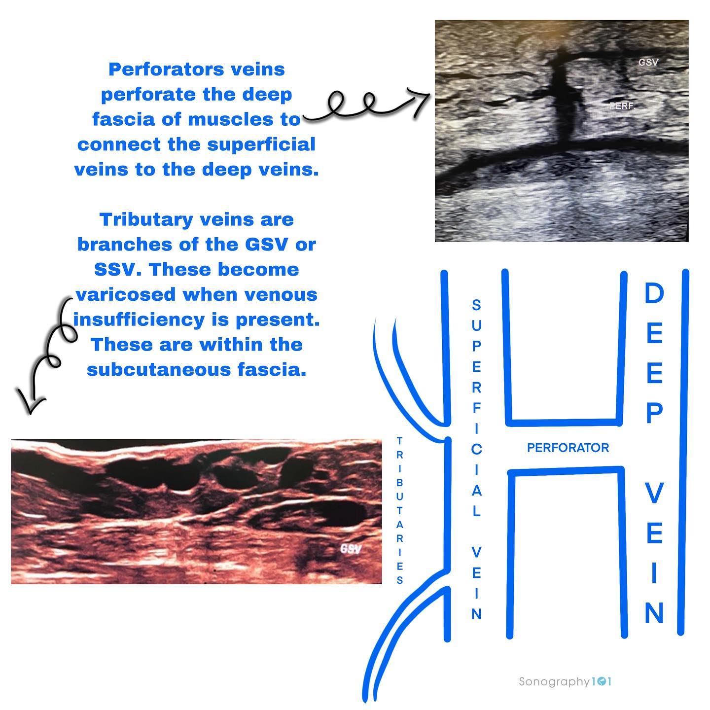 A common question when learning venous anatomy is the difference between perforators and tributaries. As seen on these images/diagrams perforator veins connect the superficial system (GSV or SSV) to the deep system (FV, PTVs, etc.), whereas tributaries are branches of the superficial system (GSV or SSV), these can become varicosed when reflux is present.
I hope this helps, as always feel free to reach out if you ever have any questions, and HAPPY SCANNING 🤗🤓
.
.
.
.
#ultrasound #sonography #medicalsonography #RDMS #RVT #RegisteredDiagnosticMedicalSonographer #RegisteredVascularTechnologist #UltrasoundTechnologist #Sonographer #UltrasoundTech #Sonography101 #ultrasoundED #ultrasononography #ultrasonographer #Medicine #Medical #Radiology #Radiologia #Ultrasonido #DiagnosticImaging #Medicina #Sonograma
#sonographystudent #sonographyschool