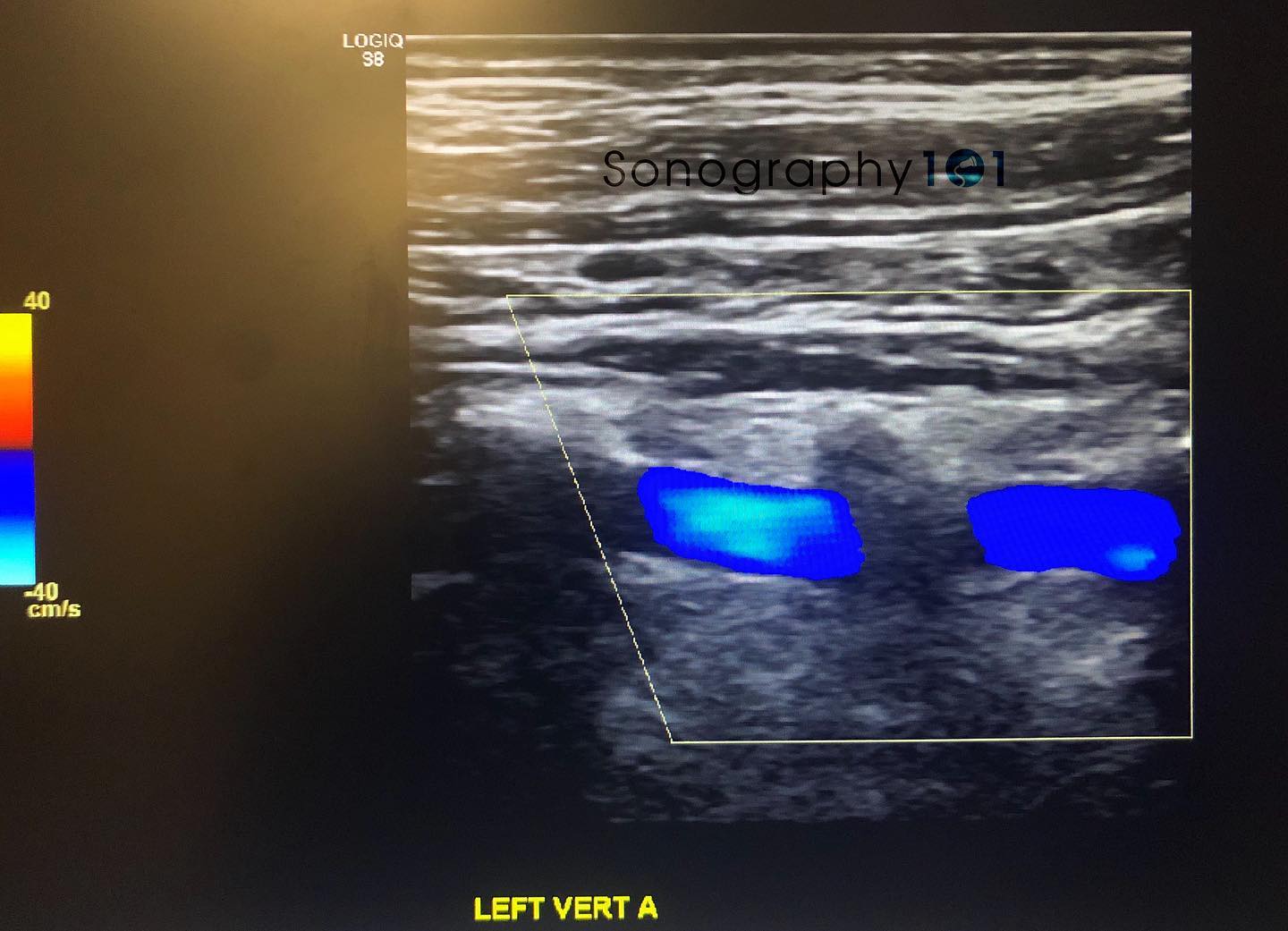 Answer to the Last What’s Wrong Wednesday ! As most of you wrote on the comments it is indeed retrograde flow in the vertebral artery secondary to subclavian steal 😁