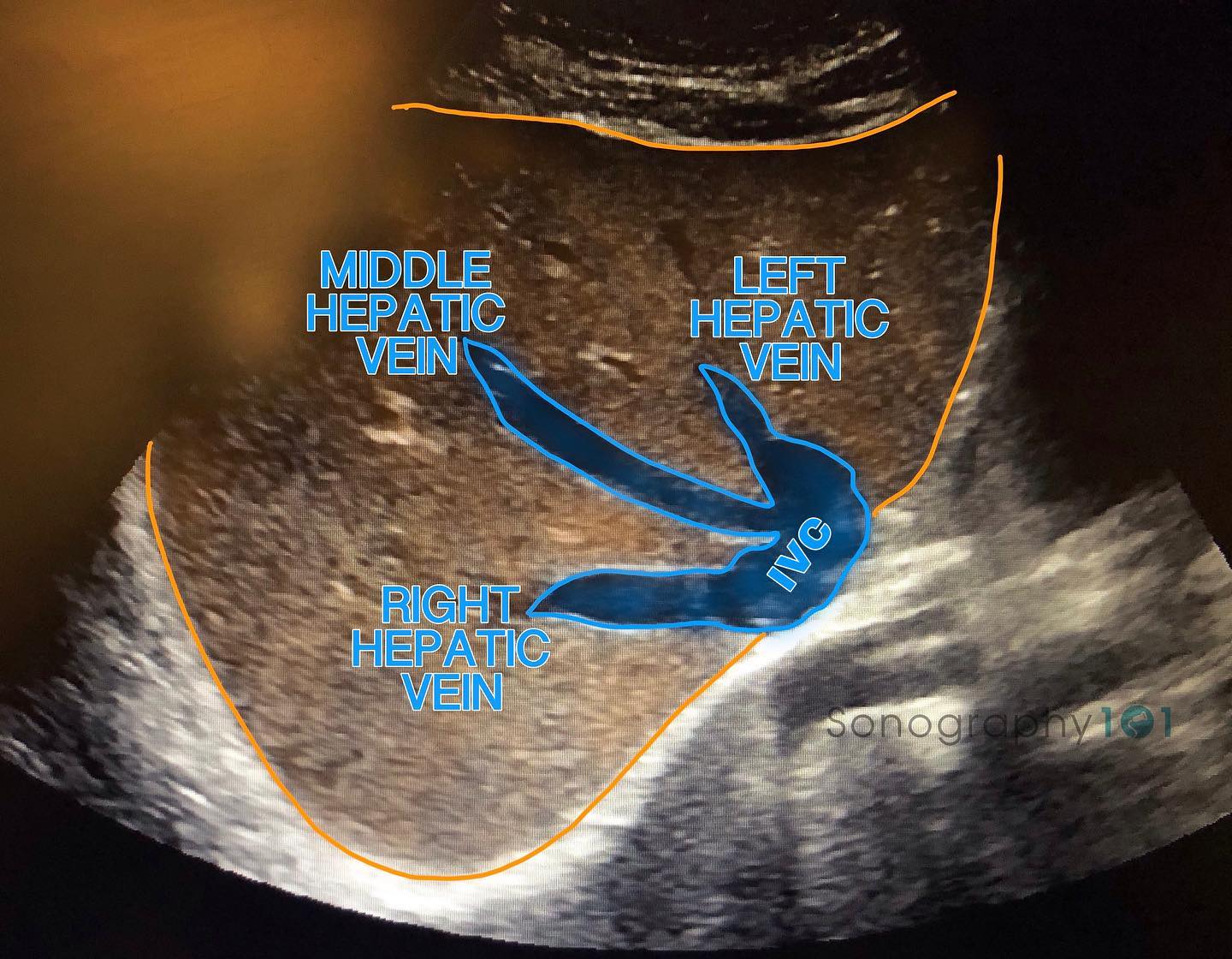 Just some pretty hepatic veins 😍
Happy Tuesday my fellow sonography peeps 🤗