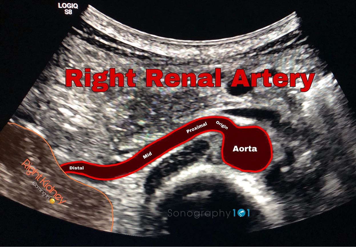 Right Renal Artery from its origin to the renal hilum.